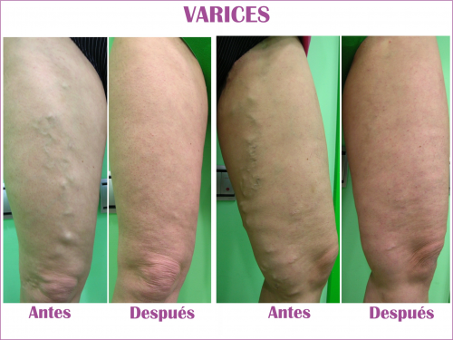 Eliminaci�n varices 01